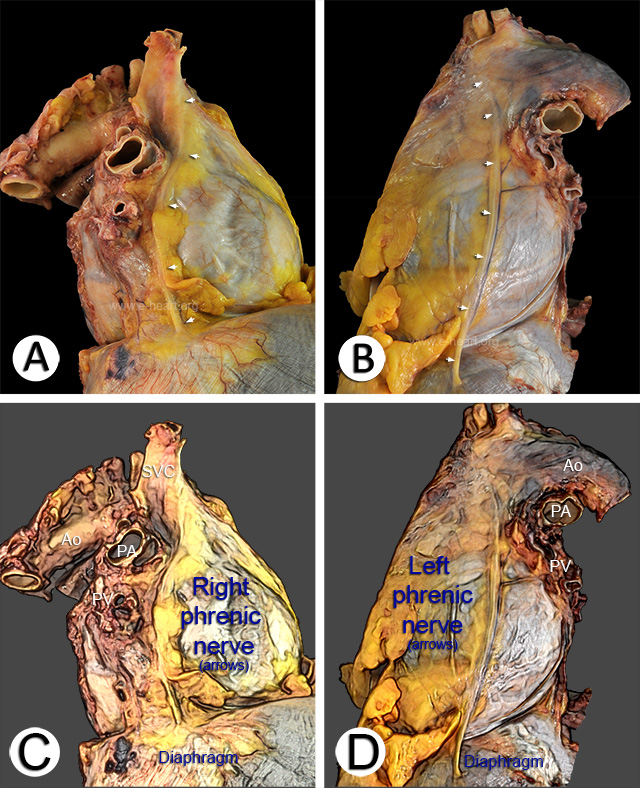 Lateral right and left views of the pericardium